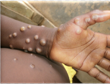 Mpox au Sénégal, Thierno Bocoum et la gouvernance de Touba