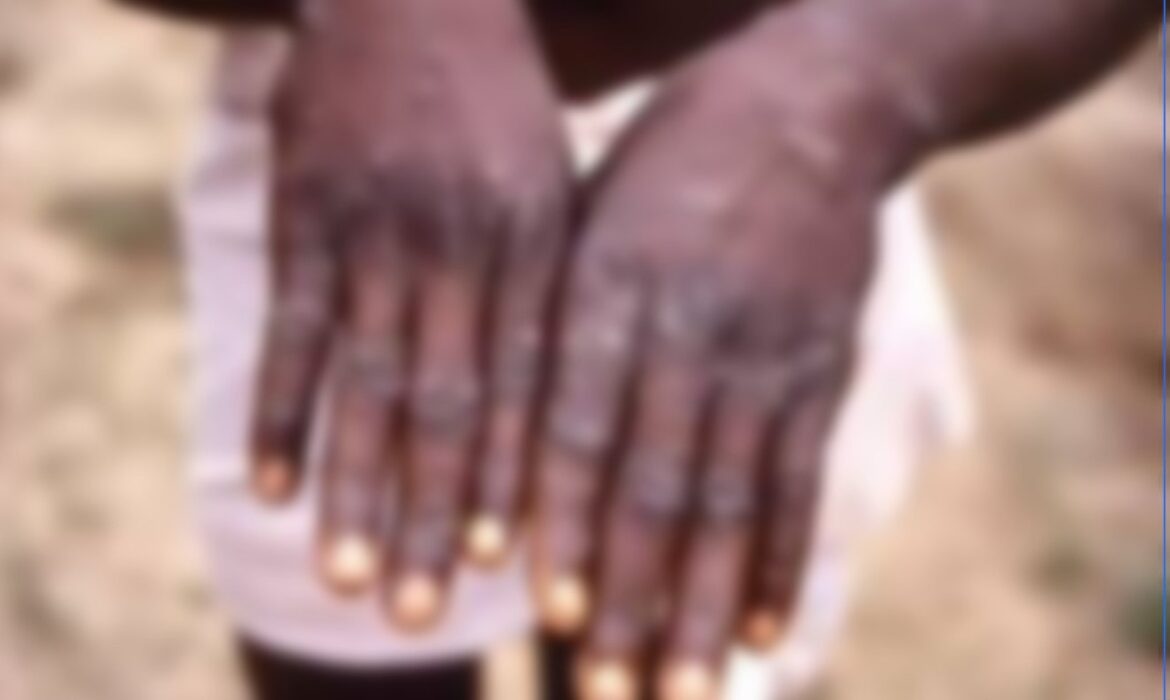 transmission, symptômes et mesures de prévention, ce qu’il faut savoir sur cette maladie