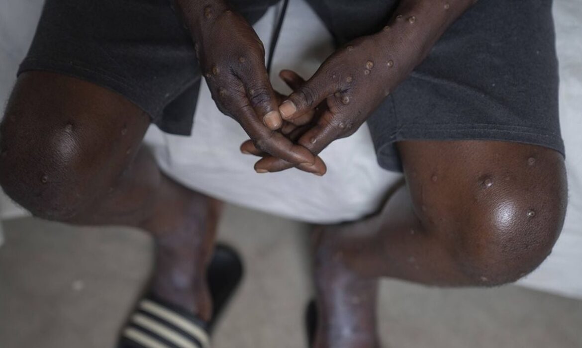 Situation préoccupante avec le Mpox et la fièvre de la Vallée du Rift